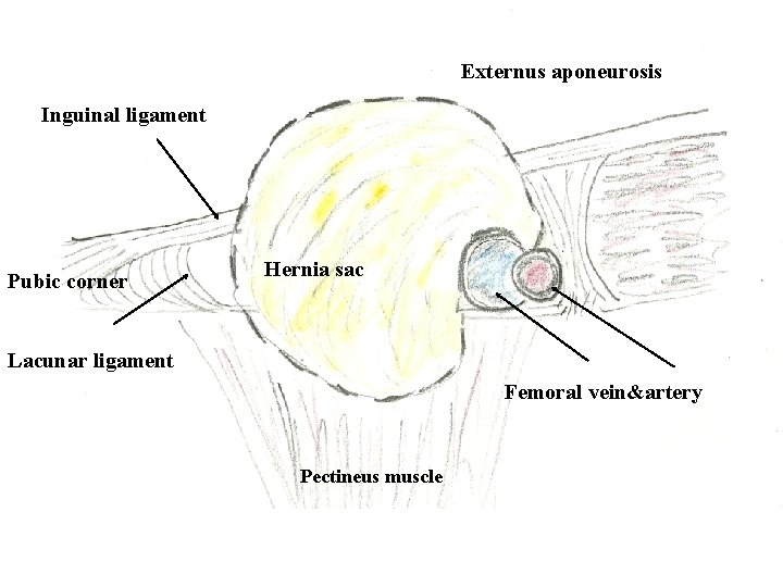 Externus aponeurosis Inguinal ligament Pubic corner Hernia sac Lacunar ligament Femoral vein&artery Pectineus muscle Externus aponeurosis Inguinal ligament Pubic corner Hernia sac Lacunar ligament Femoral vein&artery Pectineus muscle