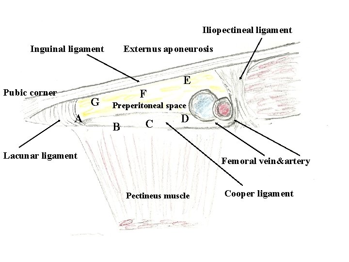 Iliopectineal ligament Inguinal ligament Externus aponeurosis E Pubic corner G A F Preperitoneal space Iliopectineal ligament Inguinal ligament Externus aponeurosis E Pubic corner G A F Preperitoneal space