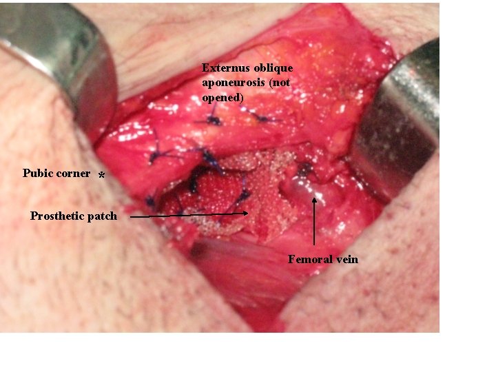 Externus oblique aponeurosis (not opened) Pubic corner * Prosthetic patch Femoral vein Externus oblique aponeurosis (not opened) Pubic corner * Prosthetic patch Femoral vein
