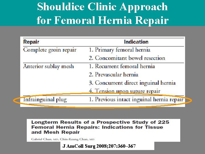 Shouldice Clinic Approach for Femoral Hernia Repair J Am. Coll Surg 2008; 207: 360– Shouldice Clinic Approach for Femoral Hernia Repair J Am. Coll Surg 2008; 207: 360–