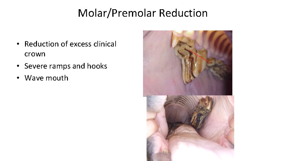 Molar/Premolar Reduction • Reduction of excess clinical crown • Severe ramps and hooks •