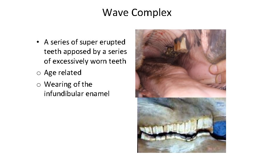 Wave Complex • A series of super erupted teeth apposed by a series of