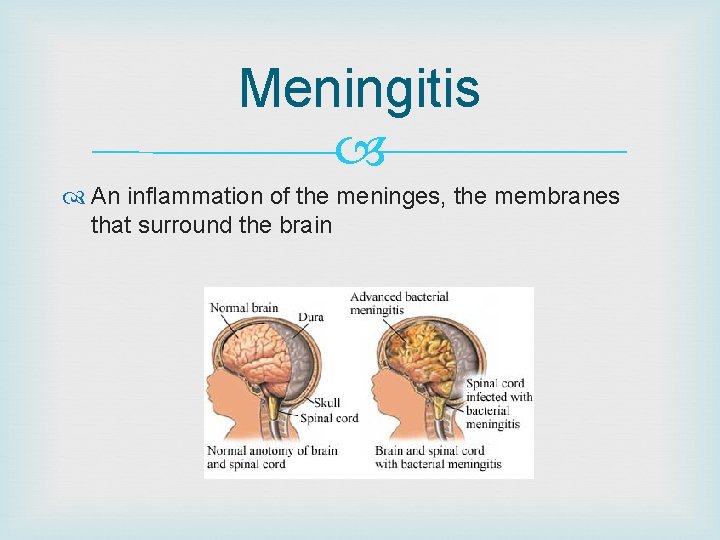 Meningitis An inflammation of the meninges, the membranes that surround the brain 