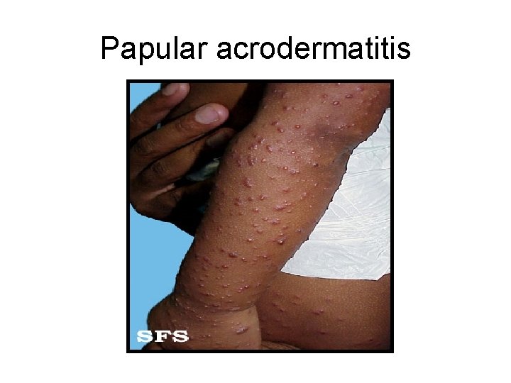 Papular acrodermatitis 