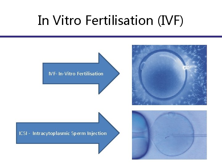 In Vitro Fertilisation (IVF) IVF- In-Vitro Fertilisation ICSI - Intracytoplasmic Sperm Injection 