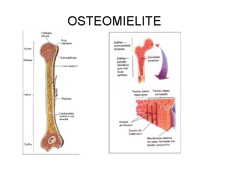 OSTEOMIELITE 