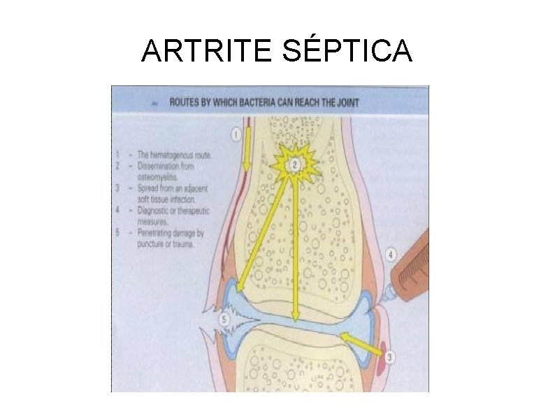 ARTRITE SÉPTICA 
