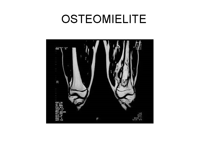 OSTEOMIELITE 