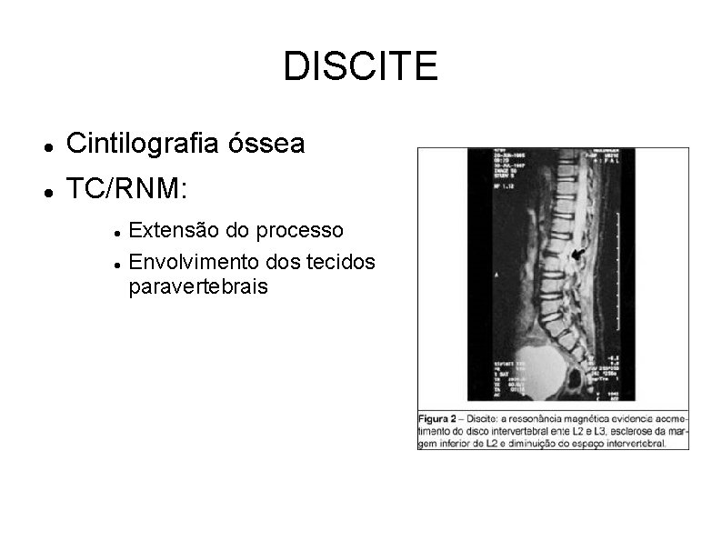 DISCITE Cintilografia óssea TC/RNM: Extensão do processo Envolvimento dos tecidos paravertebrais 