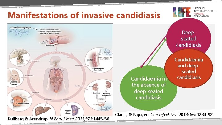 Manifestations of invasive candidiasis Deepseated candidiasis Candidaemia in the absence of deep-seated candidiasis Kullberg