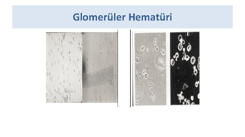 Glomerüler Hematüri 