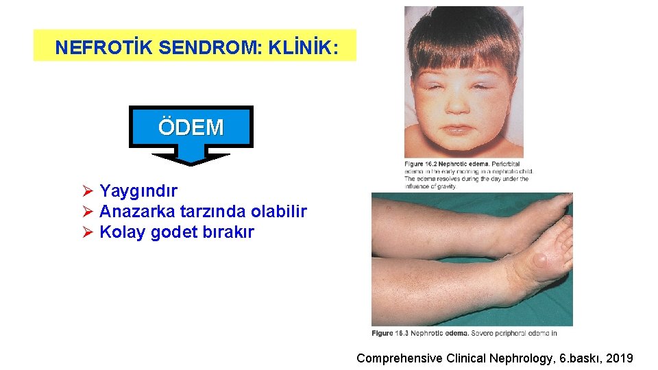 NEFROTİK SENDROM: KLİNİK: ÖDEM Ø Yaygındır Ø Anazarka tarzında olabilir Ø Kolay godet bırakır