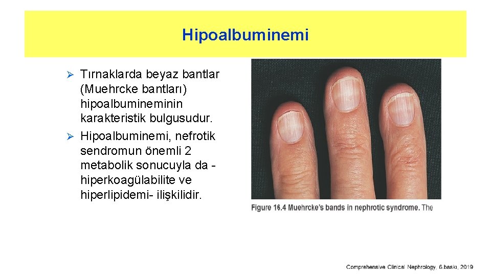 Hipoalbuminemi Tırnaklarda beyaz bantlar (Muehrcke bantları) hipoalbumineminin karakteristik bulgusudur. Ø Hipoalbuminemi, nefrotik sendromun önemli