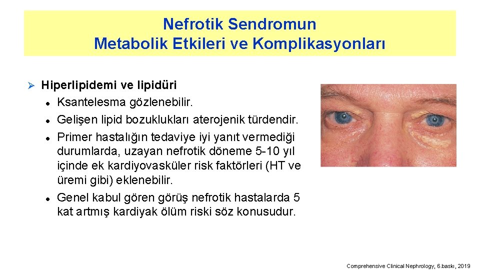Nefrotik Sendromun Metabolik Etkileri ve Komplikasyonları Ø Hiperlipidemi ve lipidüri l Ksantelesma gözlenebilir. l