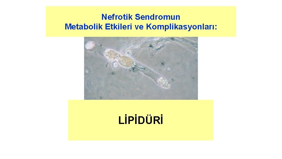 Nefrotik Sendromun Metabolik Etkileri ve Komplikasyonları: LİPİDÜRİ 