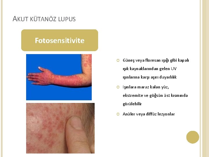 AKUT KÜTANÖZ LUPUS Fotosensitivite Güneş veya floresan ışığı gibi kapalı ışık kaynaklarından gelen UV