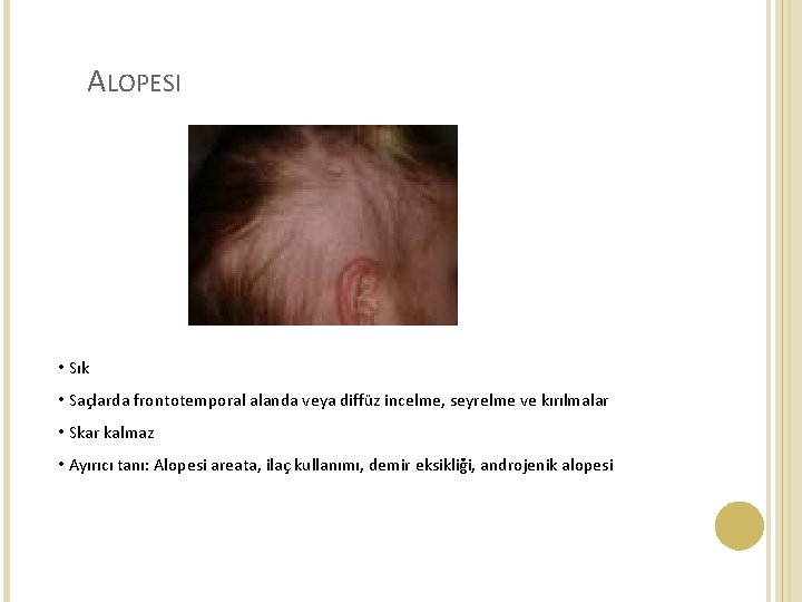  ALOPESI • Sık • Saçlarda frontotemporal alanda veya diffüz incelme, seyrelme ve kırılmalar