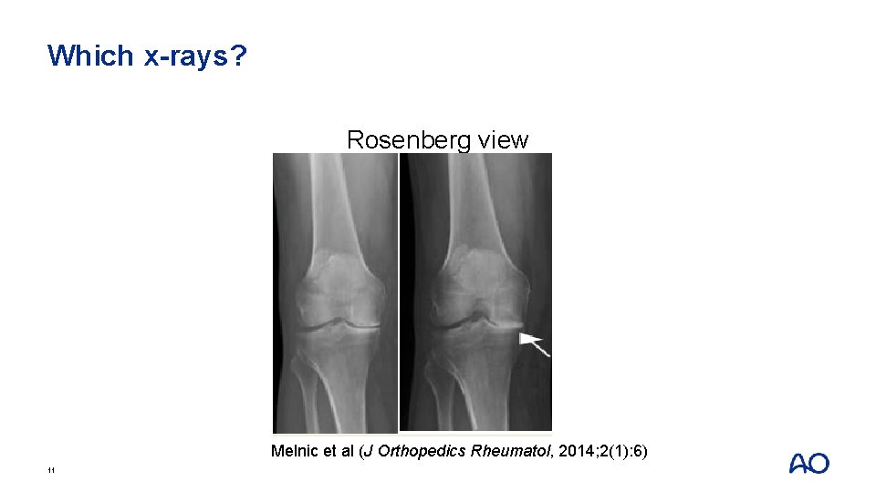 Which x-rays? Rosenberg view Melnic et al (J Orthopedics Rheumatol, 2014; 2(1): 6) 11