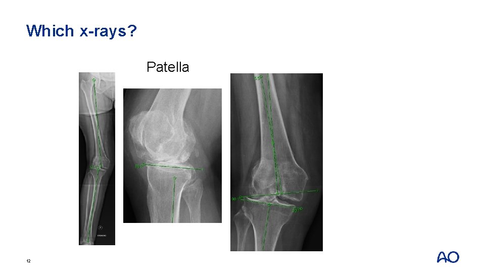 Which x-rays? Patella 12 