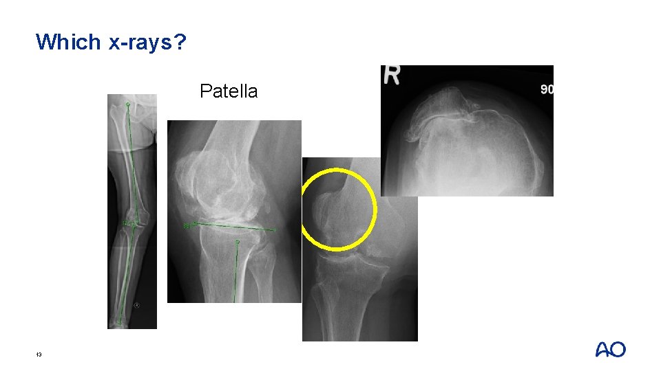 Which x-rays? Patella 13 