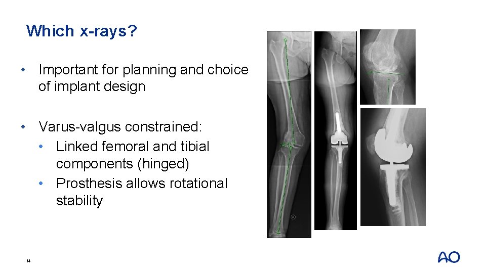 Which x-rays? • Important for planning and choice of implant design • Varus-valgus constrained:
