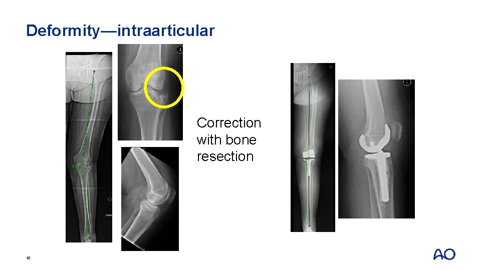 Deformity—intraarticular Correction with bone resection 15 