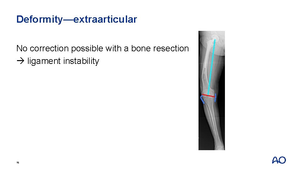 Deformity—extraarticular No correction possible with a bone resection ligament instability 16 