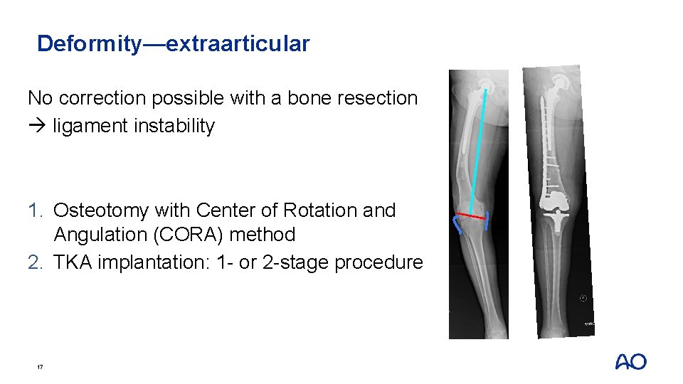 Deformity—extraarticular No correction possible with a bone resection ligament instability 1. Osteotomy with Center