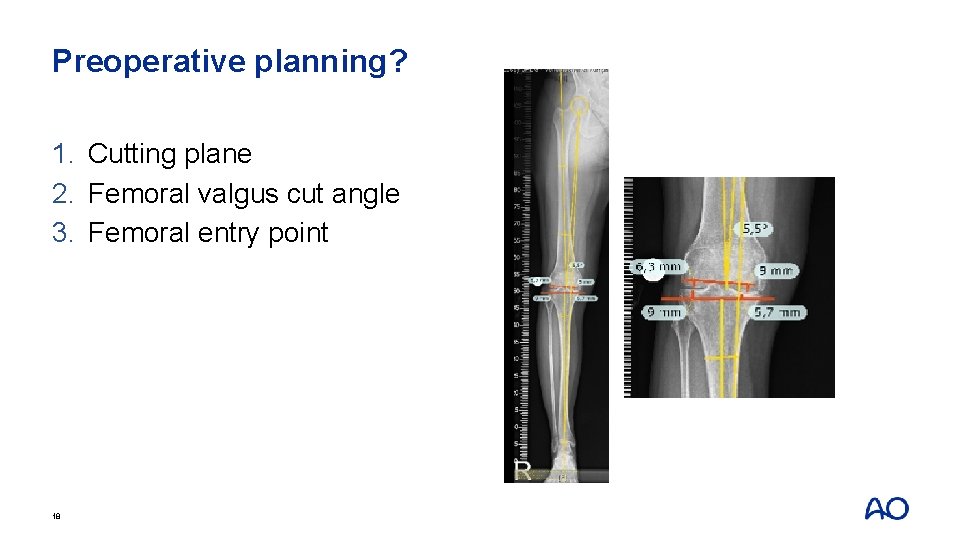 Preoperative planning? 1. Cutting plane 2. Femoral valgus cut angle 3. Femoral entry point