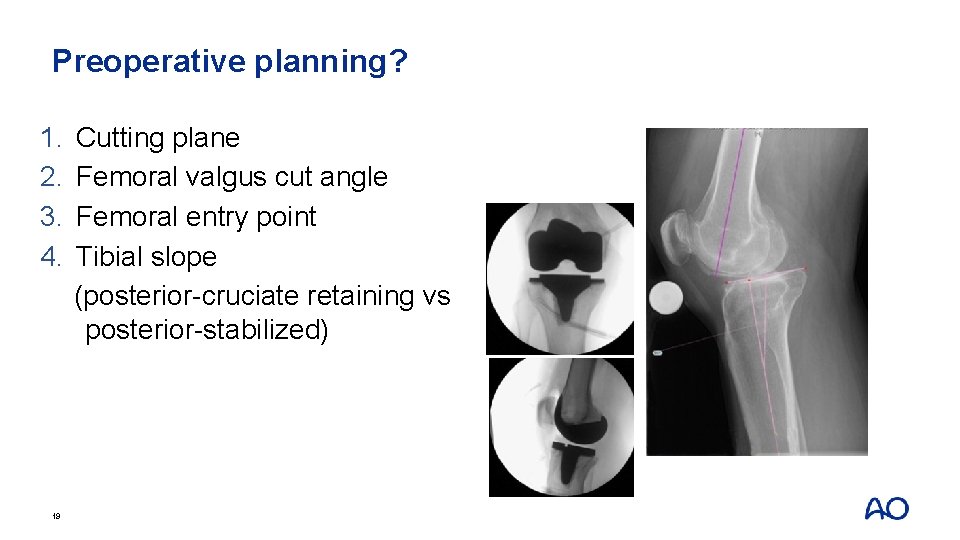 Preoperative planning? 1. 2. 3. 4. 19 Cutting plane Femoral valgus cut angle Femoral