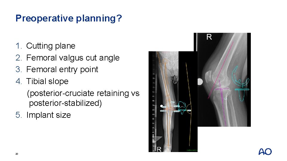 Preoperative planning? 1. 2. 3. 4. Cutting plane Femoral valgus cut angle Femoral entry