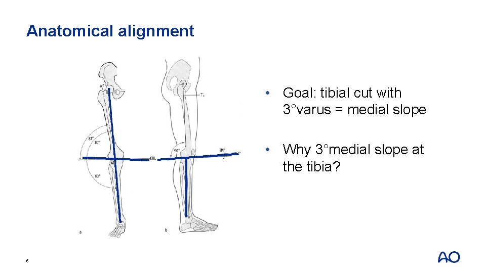 Anatomical alignment • Goal: tibial cut with 3°varus = medial slope • Why 3°medial