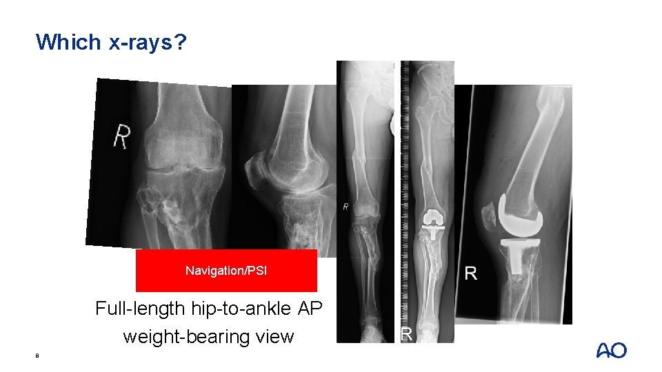 Which x-rays? Navigation/PSI Full-length hip-to-ankle AP weight-bearing view 8 