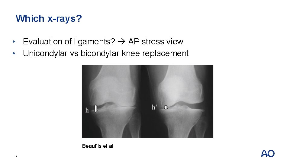 Which x-rays? • Evaluation of ligaments? AP stress view • Unicondylar vs bicondylar knee