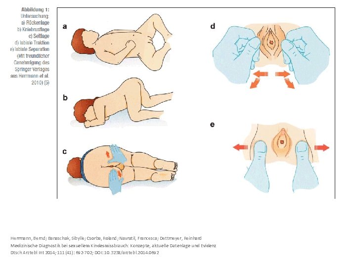 Herrmann, Bernd; Banaschak, Sibylle; Csorba, Roland; Navratil, Francesca; Dettmeyer, Reinhard Medizinische Diagnostik bei sexuellem