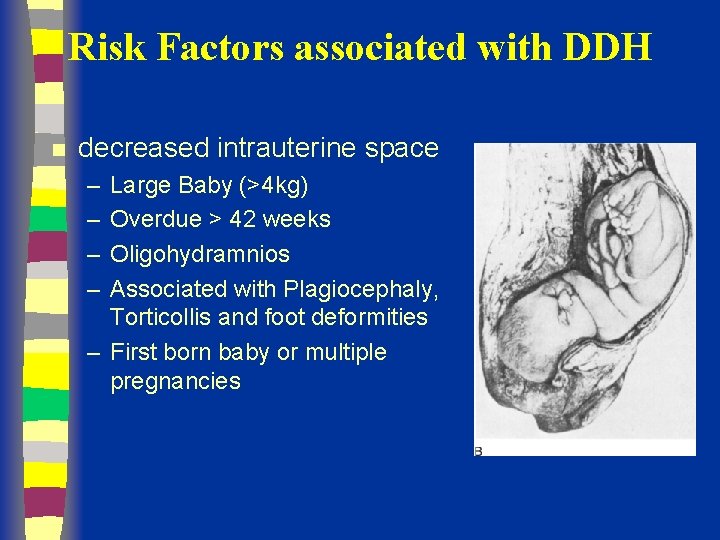 Risk Factors associated with DDH n decreased intrauterine space – – Large Baby (>4