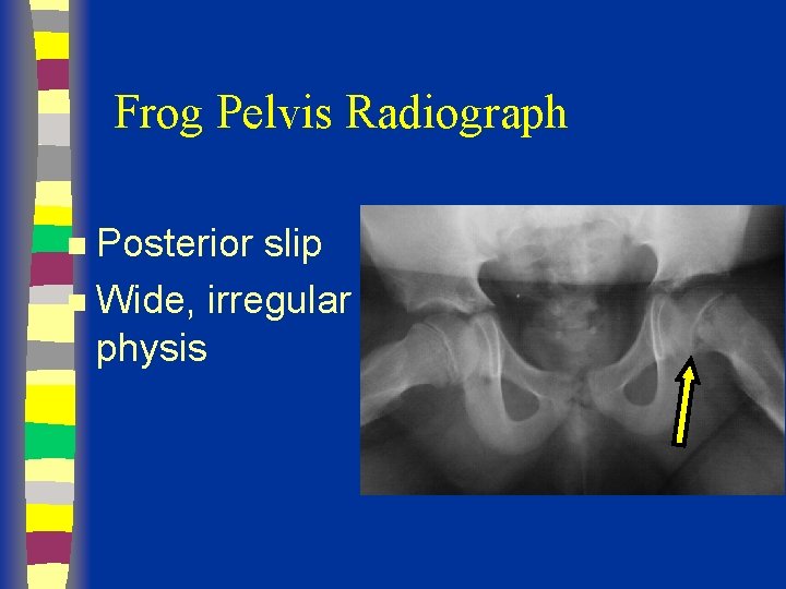 Frog Pelvis Radiograph Posterior slip n Wide, irregular physis n 