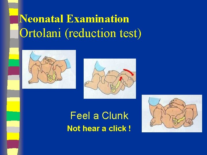 Neonatal Examination Ortolani (reduction test) Feel a Clunk Not hear a click ! 