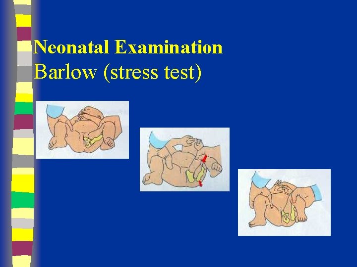 Neonatal Examination Barlow (stress test) 