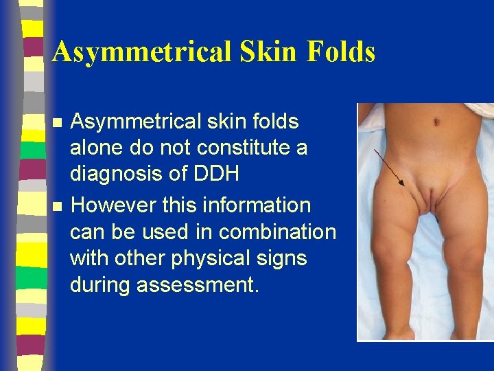 Asymmetrical Skin Folds n n Asymmetrical skin folds alone do not constitute a diagnosis