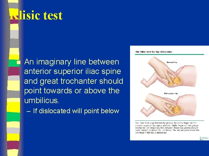 Klisic test n An imaginary line between anterior superior iliac spine and great trochanter