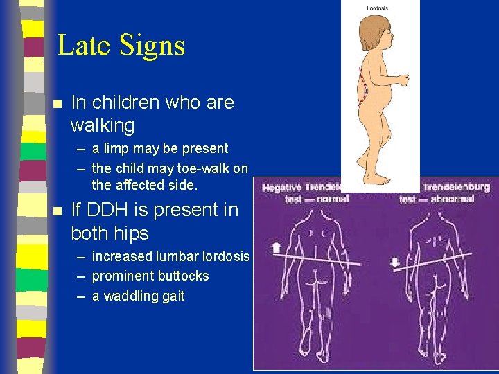 Late Signs n In children who are walking – a limp may be present