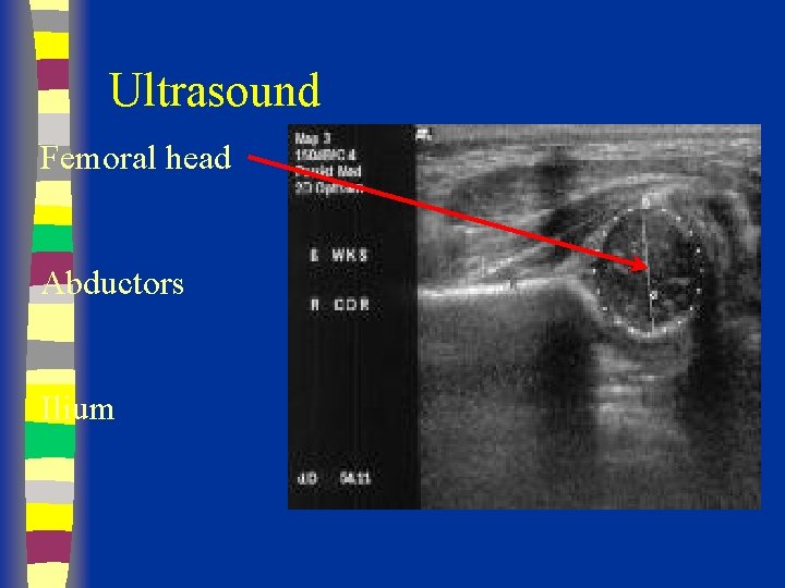 Ultrasound Femoral head Abductors Ilium 