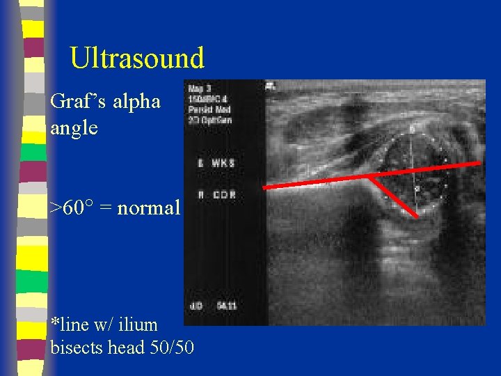 Ultrasound Graf’s alpha angle >60 = normal *line w/ ilium bisects head 50/50 