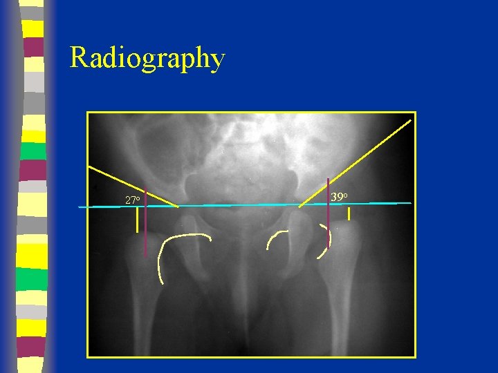 Radiography 27 o 39 o 