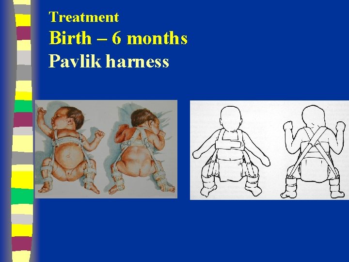 Treatment Birth – 6 months Pavlik harness 