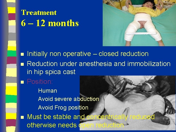Treatment 6 – 12 months n n n Initially non operative – closed reduction