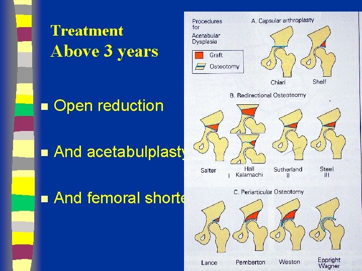 Treatment Above 3 years n Open reduction n And acetabulplasty n And femoral shortening