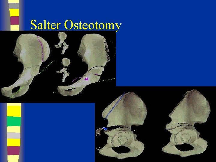 Salter Osteotomy 