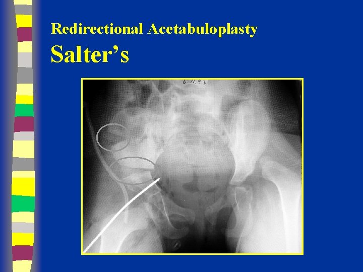 Redirectional Acetabuloplasty Salter’s 